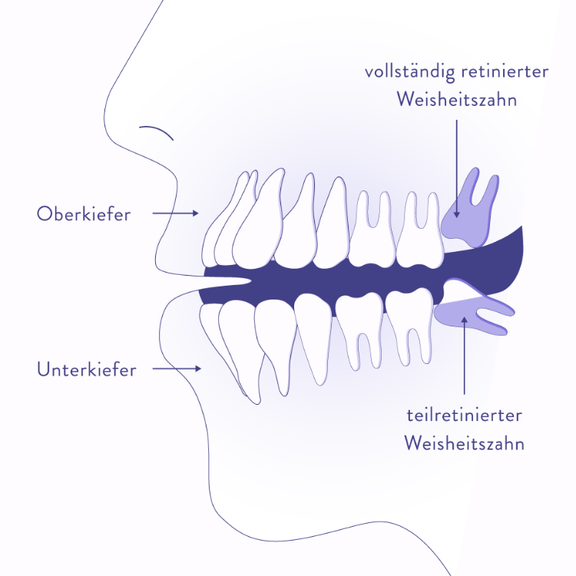 Weisheitszähne, Zahnarzt Zürich, finest smile